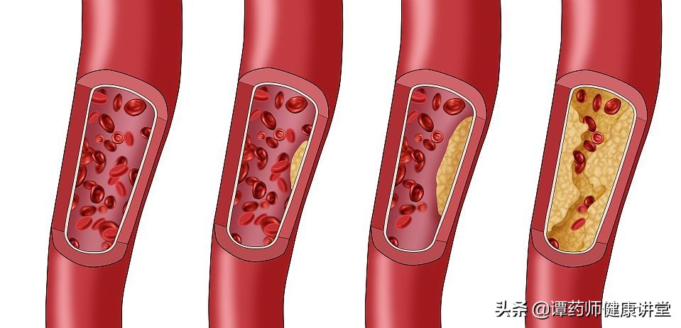 阿托伐他汀降价了吗,国家集采药品他汀类有哪些