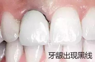 做烤瓷牙后现在全坏了怎么办,烤瓷牙一般多久需要更换