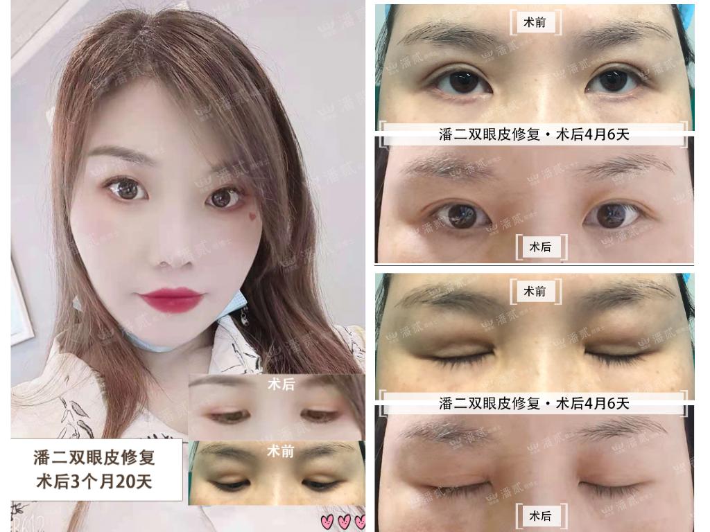 10年前做过韩式双眼皮,做过韩式三点双眼皮还能开眼角吗