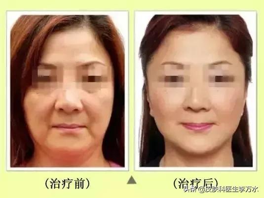 超声刀美容真的像张雨绮吗,张雨绮超声刀图片