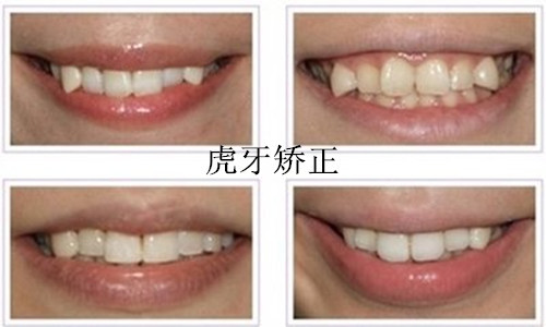 儿童老虎牙矫正,儿童虎斑牙怎么解决