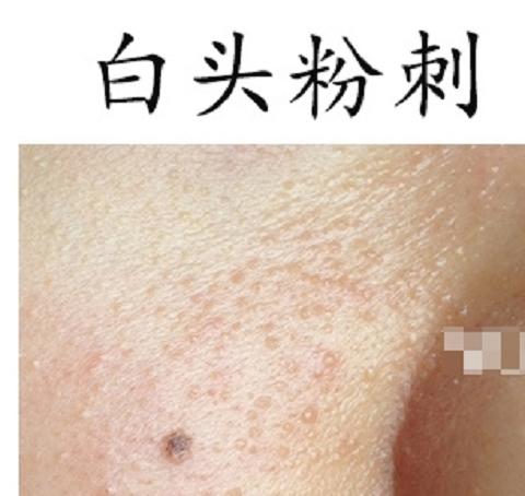 皇家雨燕教你痘痘肌の正确保养方式