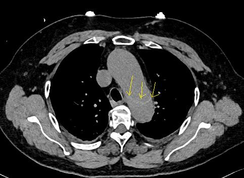 如何监测动脉夹层早期,动脉增强ct能查出主动脉夹层么