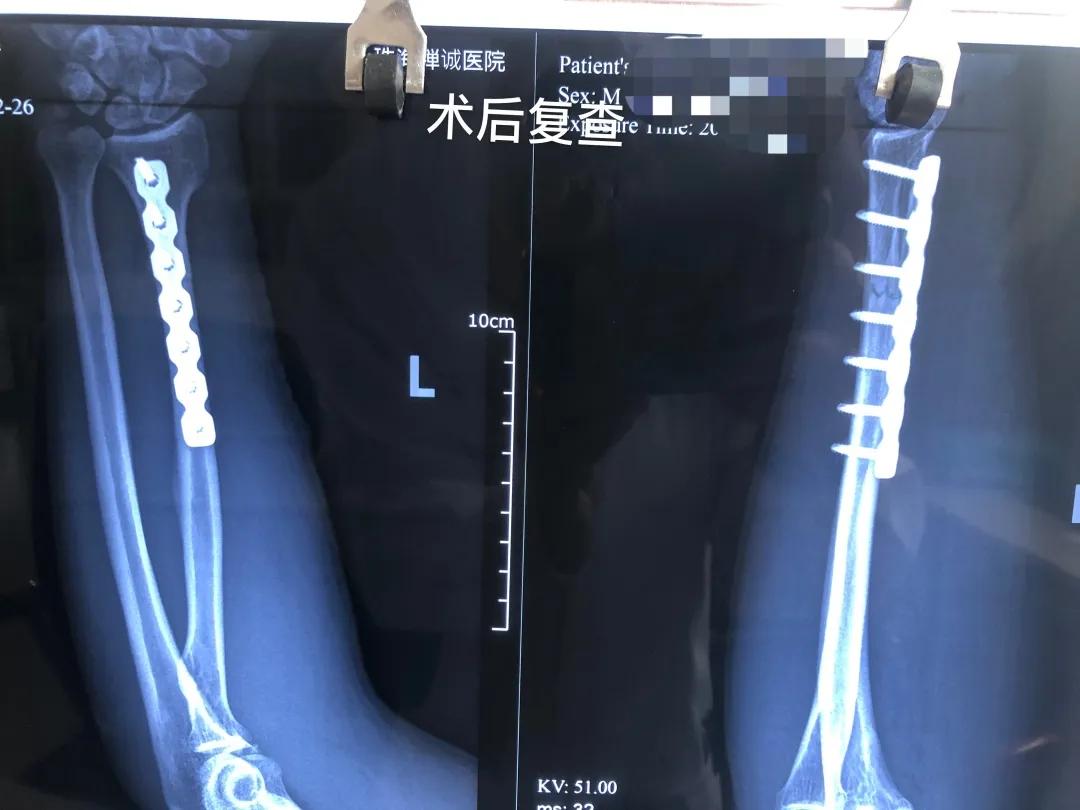 摔了一下手臂桡骨骨折,摔倒时手掌撑地引起手腕桡骨骨折