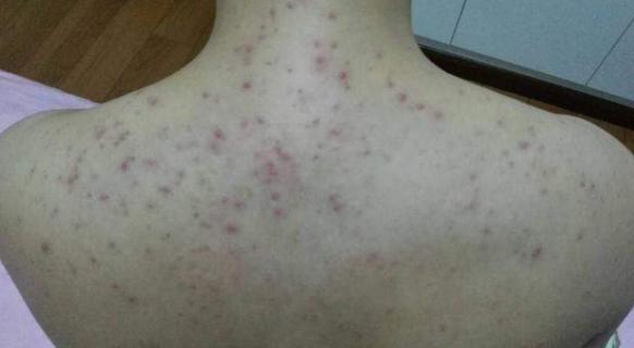 背上起痘有什么办法祛痘,后背祛痘最有效的药膏