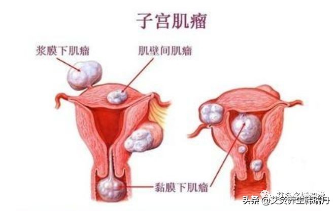 子宫肌瘤结节能治愈吗,中医消除肝结节最有效的方法