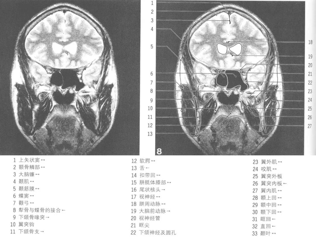 颅脑冠状状切面解剖图,颅脑mr解剖结构图