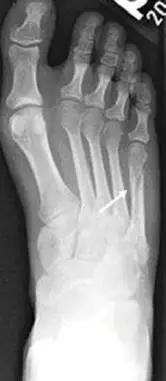 所有骨折都叫什么名字,骨折的名称有哪些