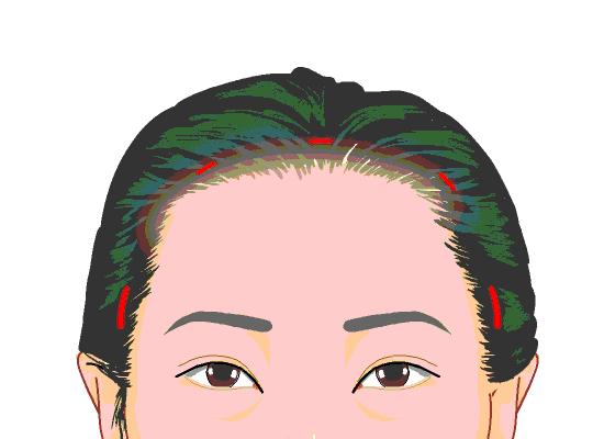 内窥镜提眉和手术提眉哪个好,提眉术和切眉手术哪个简单