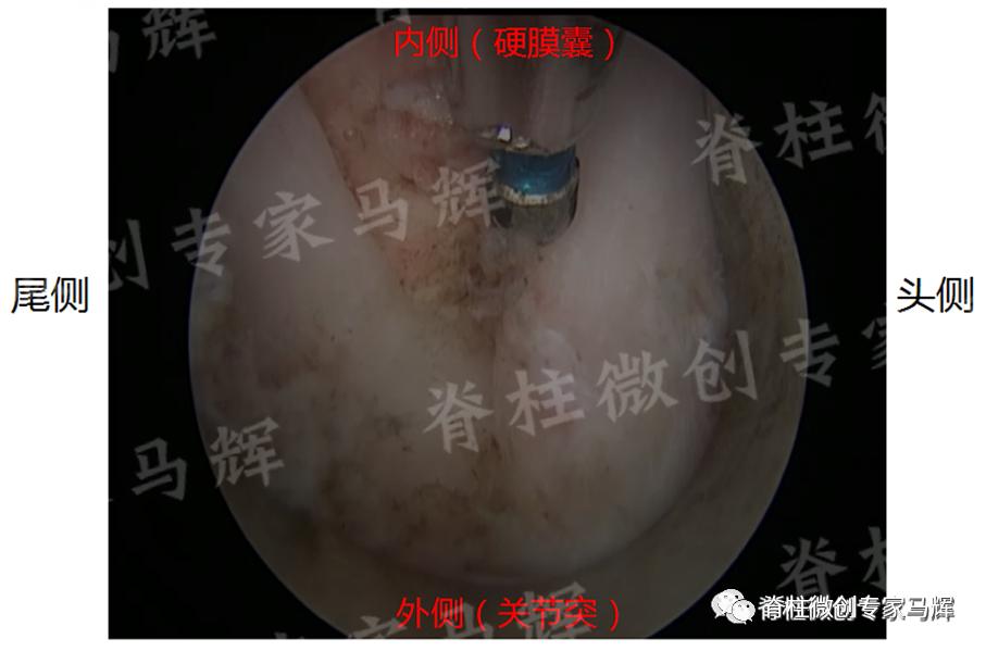 脊椎狭窄压迫神经腿疼怎么治疗,神经根痛上肢麻木怎么康复