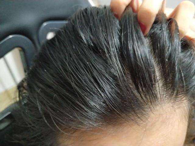 头发又油又痒还长痘痘是什么原因,14岁男孩头发里长痘痘怎么回事