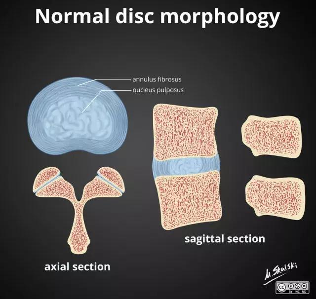 椎间盘脱出和突出片子怎么看,椎间盘膨出的鉴别诊断