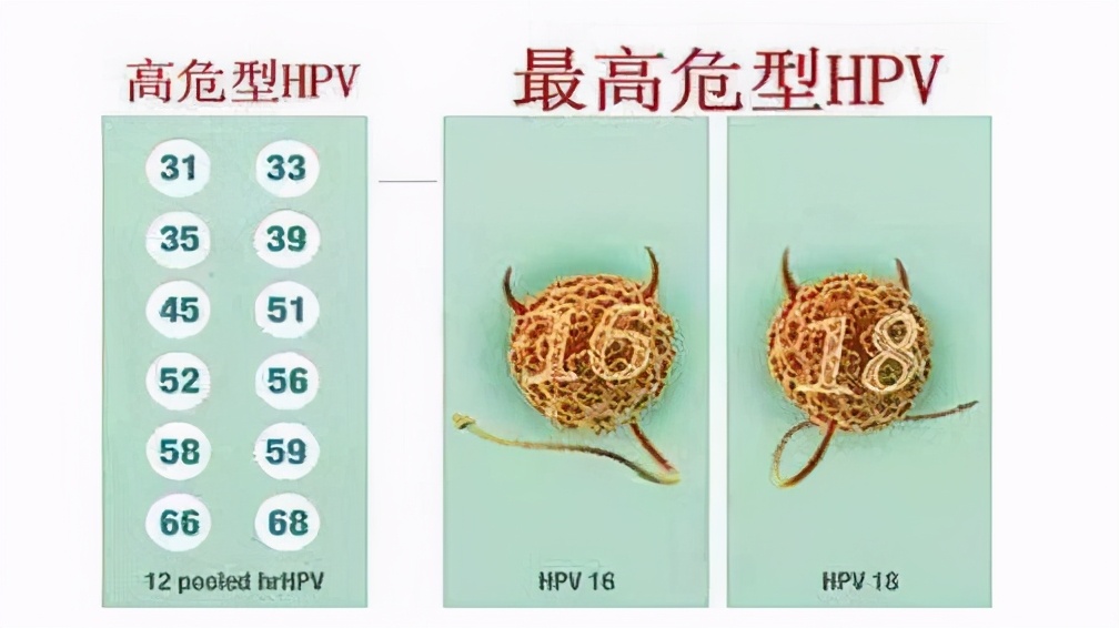tct没问题hpv18却是阳性,tct阴性hpv18阳性患癌几率