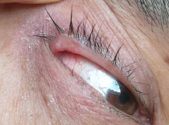 眼整形修复权威科普,科普眼整形手术是个什么手术多图