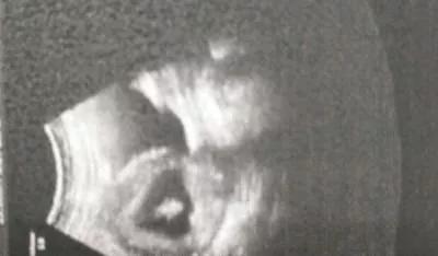 尿素偏高是肾功能不全吗,肾功能检查尿素略高