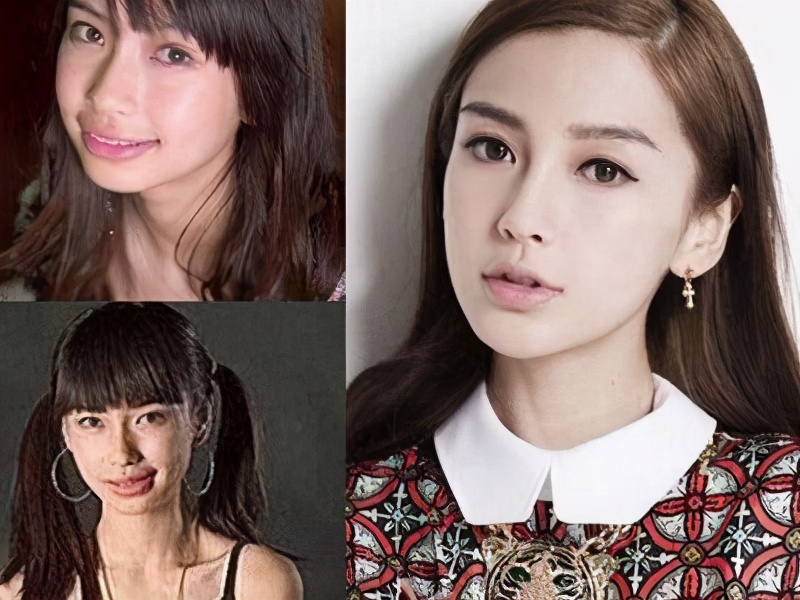 隆鼻对皮肤有什么影响,隆鼻对颜值有多大影响