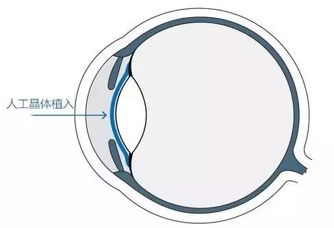 最新黑科技近视手术,黑科技近视治疗