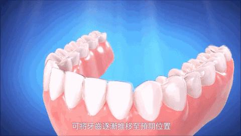 今年种植牙齿进医保了吗,矫正牙齿不给报销吗