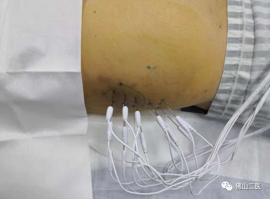 官宣丨阿伯腰腿疼痛多年，康复科首行“内热针”治疗帮其缓解