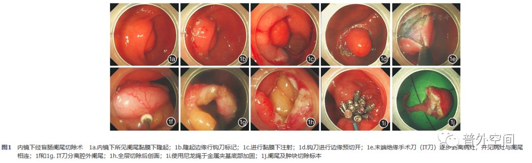 内镜下阑尾切除手术成功案例,肠镜下阑尾切除术哪里能做