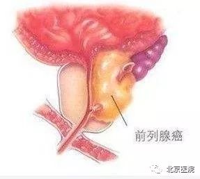 第12届北京医院前列腺癌患者俱乐部活动通知