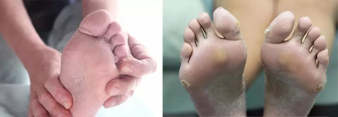 香港脚怎么彻底治愈,香港脚怎么根除