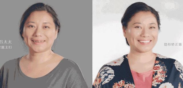 今年种植牙齿进医保了吗,矫正牙齿不给报销吗