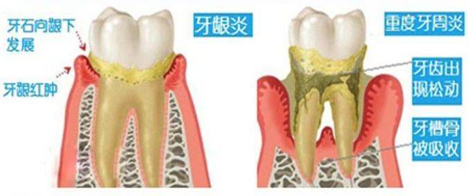 防蛀牙膏智商税,牙龈止血牙膏真的有用吗