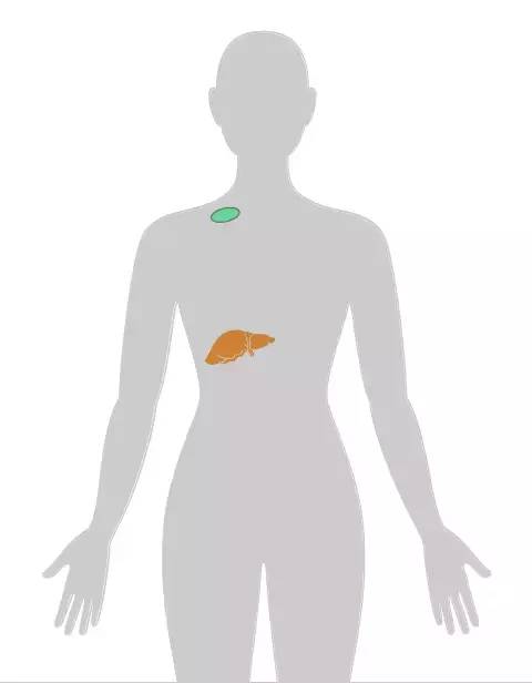 18张癌症人体地图，揭秘致癌真相！