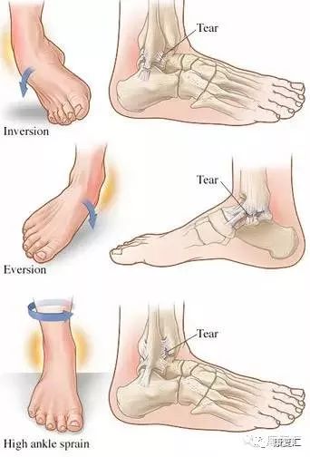 脚踝扭伤很痛怎么医,脚踝内侧筋痛扭伤详细康复训练
