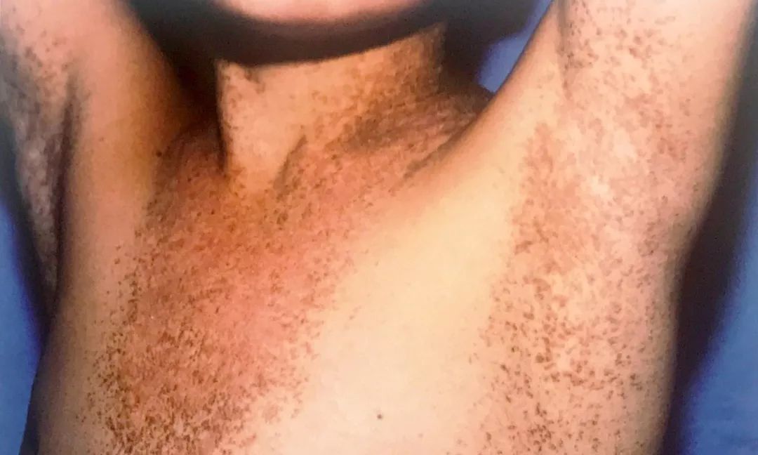 鸡皮肤很严重被嫌弃,一招告别鸡皮肤养成光滑肌