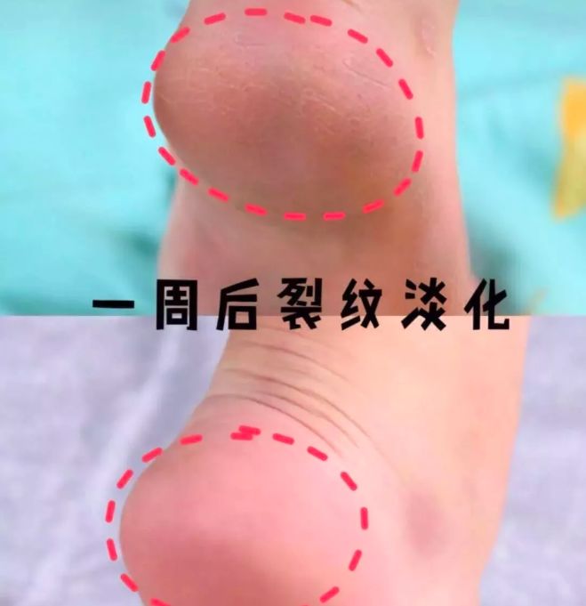 呵护手足|戴手套=精油SPA？还不耽误玩手机？30分钟急救手膜足膜，死皮老茧全消失，让你从头嫩到脚