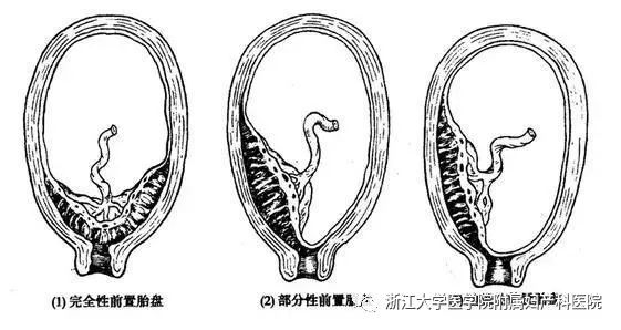 生孩子大出血概率很高吗,生孩子大出血最好的解决办法