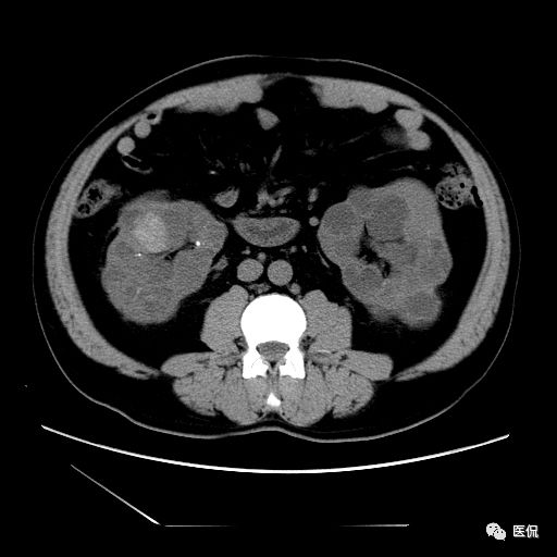 肾功能不全双肾回声稍增强怎么办,肾ct检查双肾萎缩