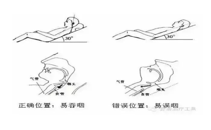 了解吞咽障碍的症状和预防措施,吞咽障碍的相关知识