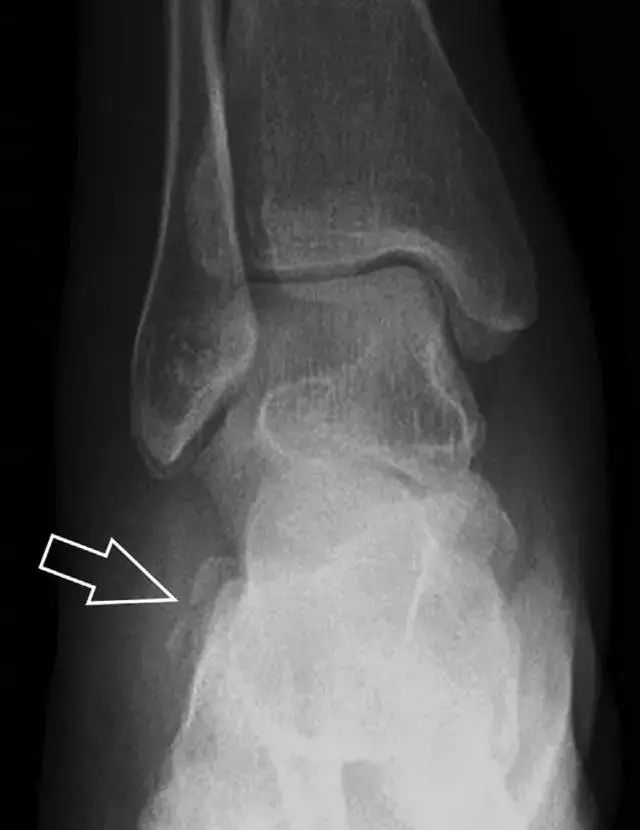 肩关节脱位易漏诊的骨折,放射科容易漏诊的骨折