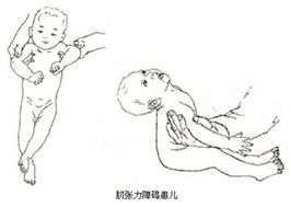 「健康」婴幼儿早期干预的必要性