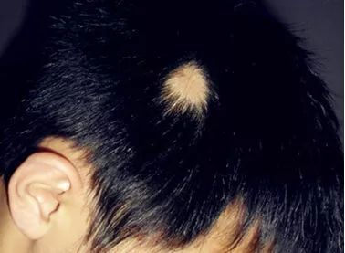 共享大医生｜谁来拯救我的发际线？