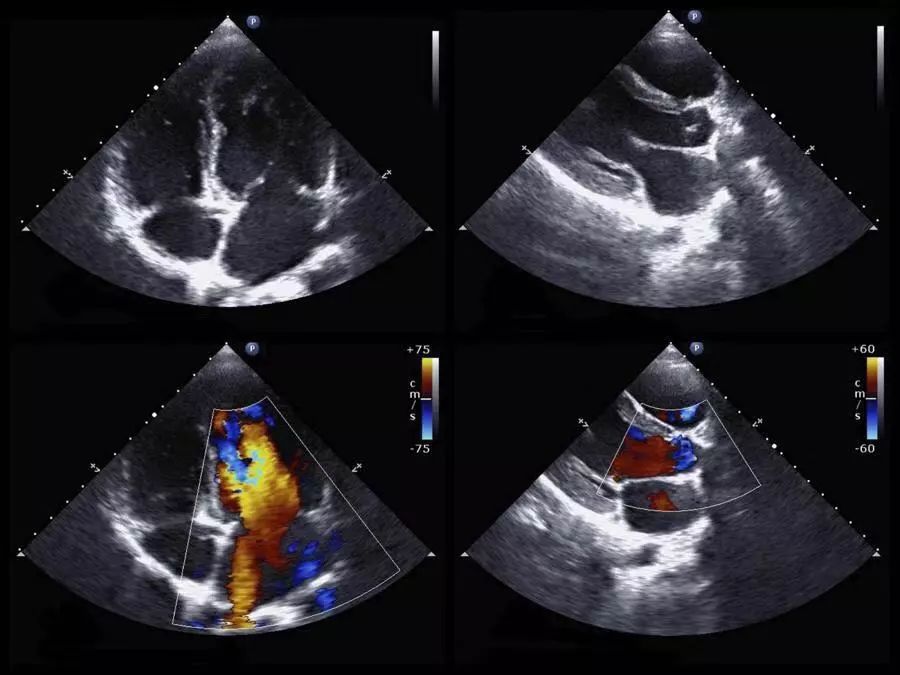 左心舒张功能减退的治疗方法,左心室增大左心舒张功能减退