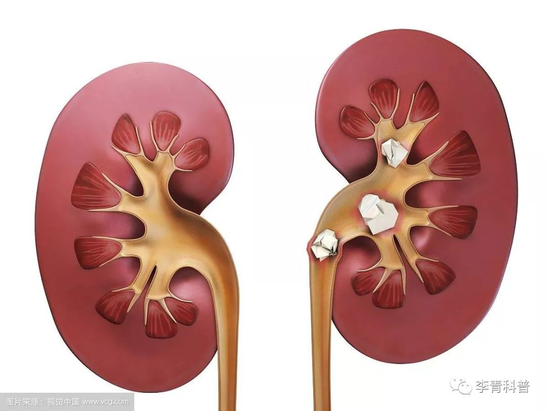 得了一次肾结石可能永远不复发么,一年内得了好几次肾结石