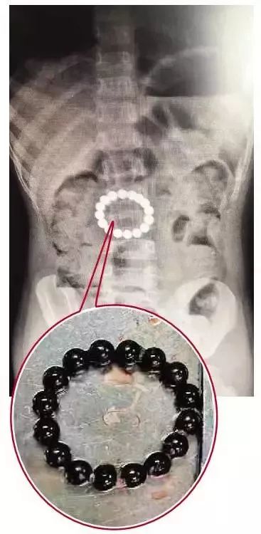 吸铁石不小心让孩子吞了有危害吗,熊孩子吸铁石