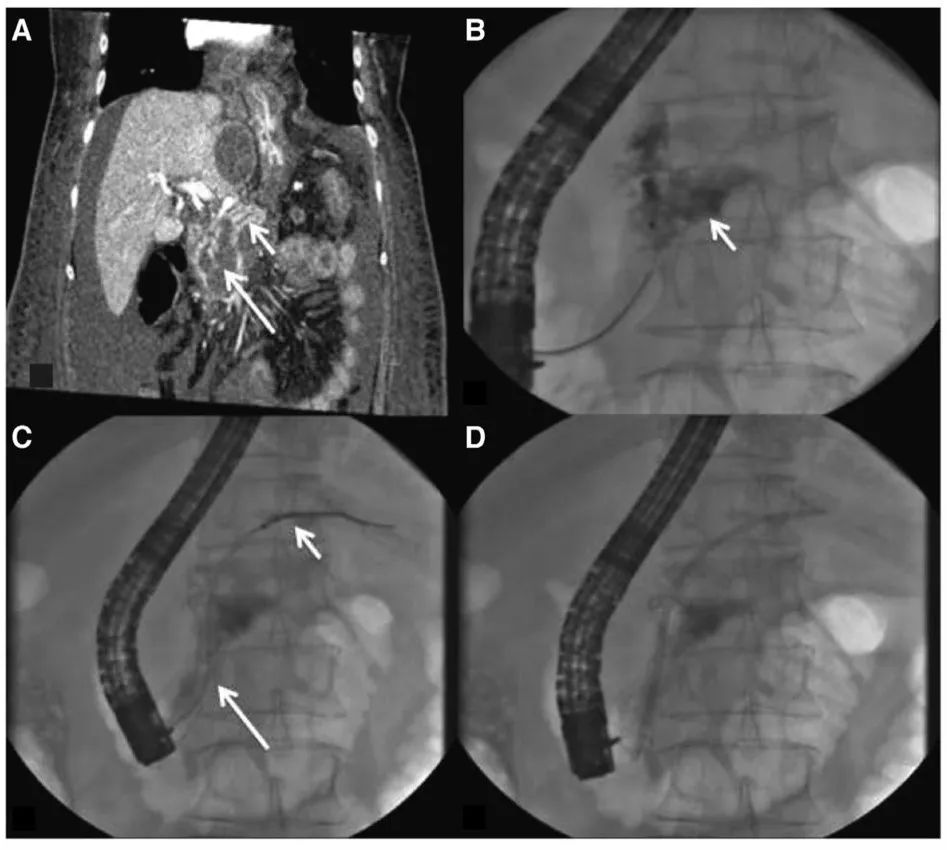 权威研究说,胰腺液体积聚引流,内镜可以这样用