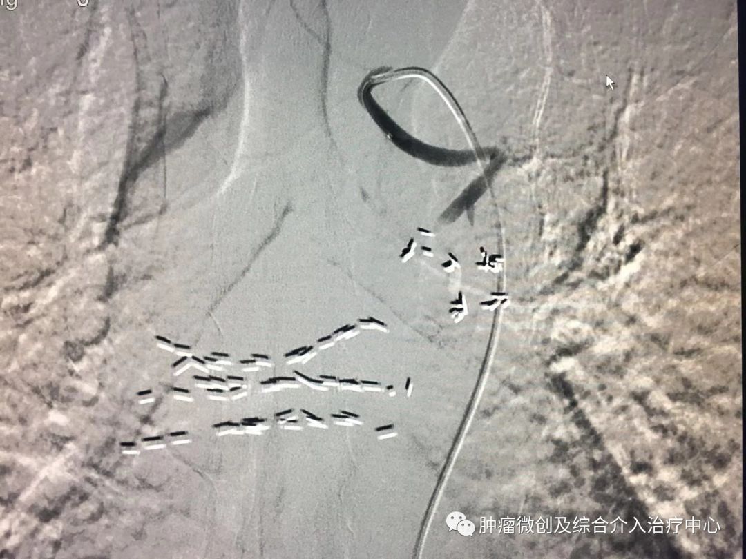 运城市第一医院肿瘤科咋样,运城第一医院治疗肿瘤怎么样