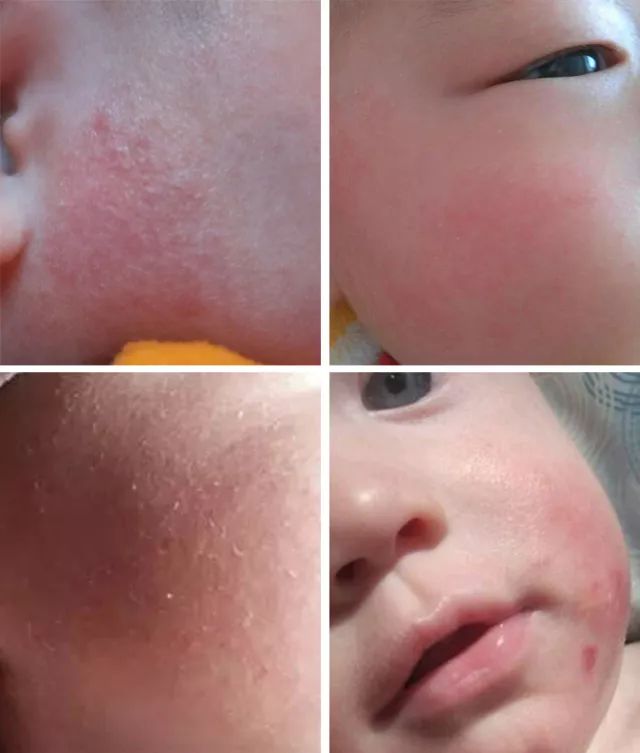 护肤春夏儿童,肌肤护理宝宝