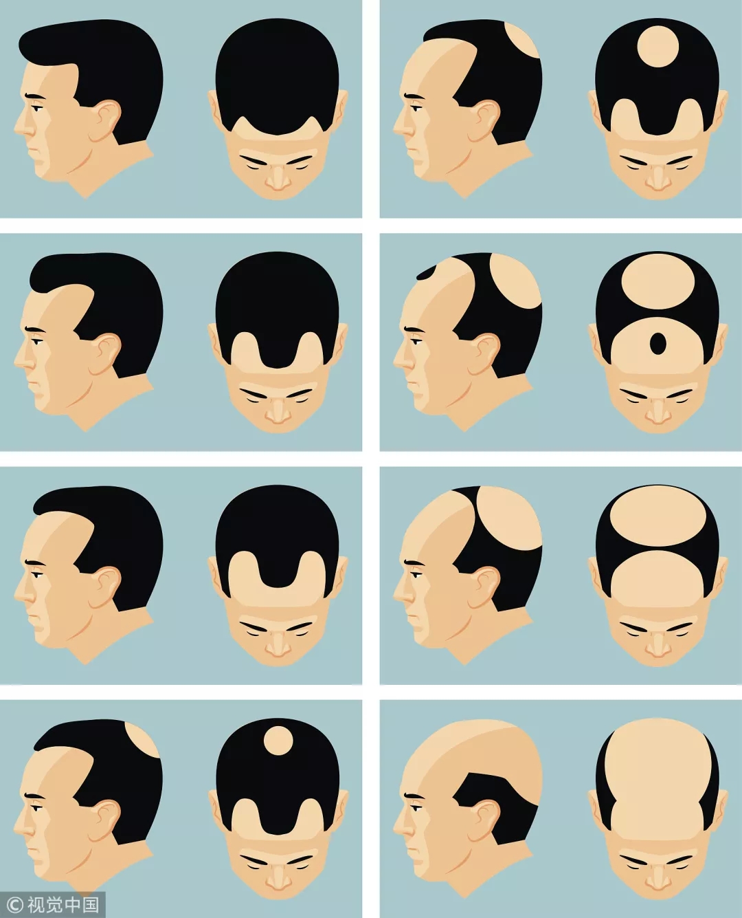 年纪轻轻就脱发用什么药好,年纪轻轻就脱发严重怎么办