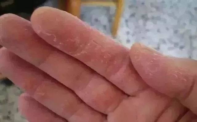 脚后跟干裂修复霜去死皮,脚干裂脱皮修复霜