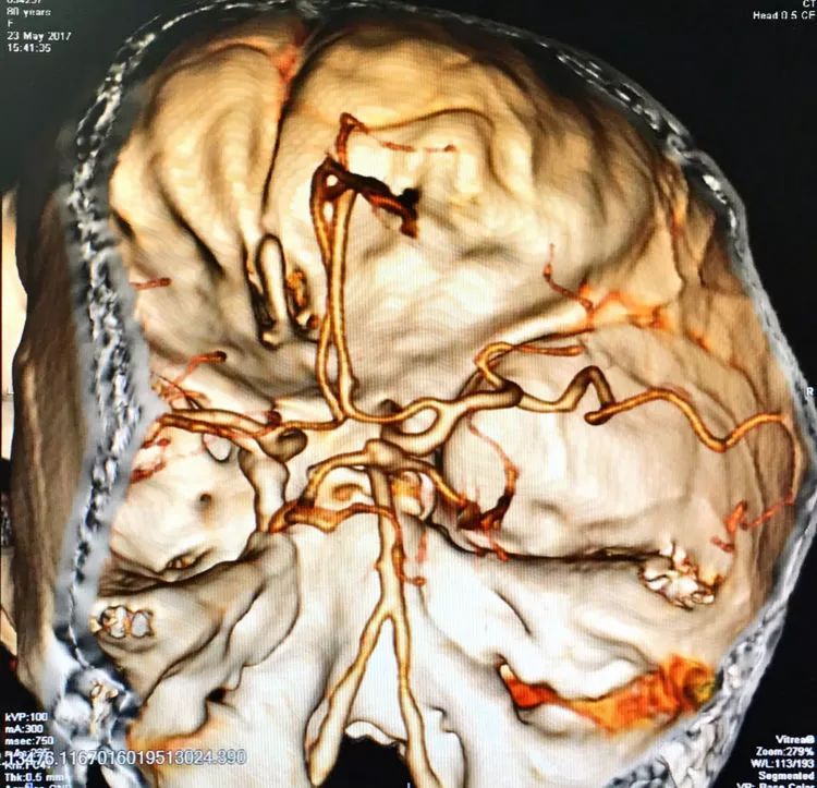 柳暗花明专栏｜栓塞颅内动脉瘤时微导管无法穿过LVIS支架网眼怎么办