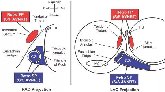 女孩无休止室上速?“真凶”样子有点“怪”!