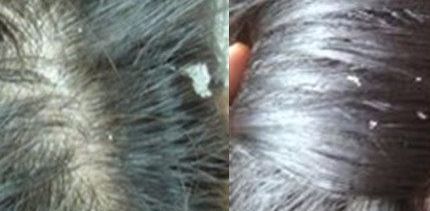 头皮屑洗不掉怎么办有什么方法,头发头皮屑多且大块还结痂有虫