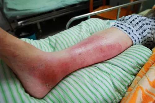 暴雨天出门，江西男子染上这种病！医生提醒：严重可致命